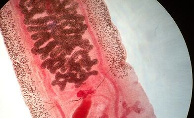 Anilistomosis in humans