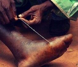 Parasite at the foot of the person