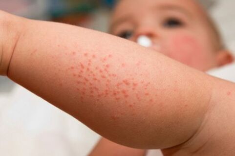 Allergy in a child as a symptom of the presence of worms